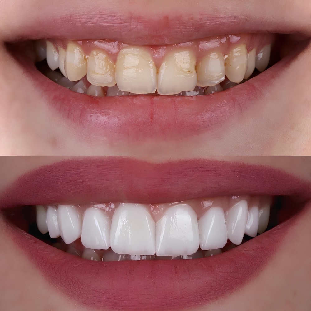 Transform Your Smile with Veneers in Westlake Village