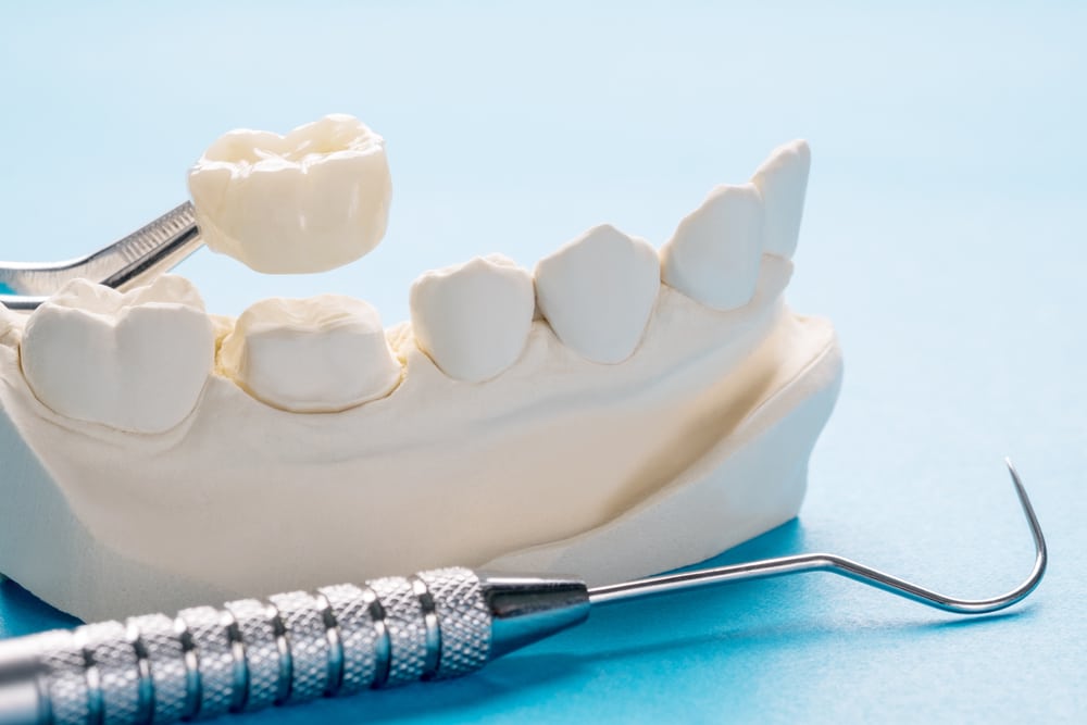 Restore and Strengthen Your Smile With Dental Crowns in Westlake Village