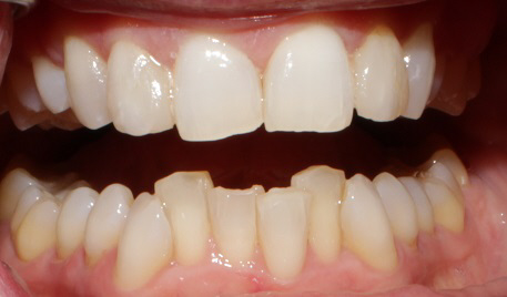 Smile Gallery case 1, before treatment, Westlake Village Dentist
