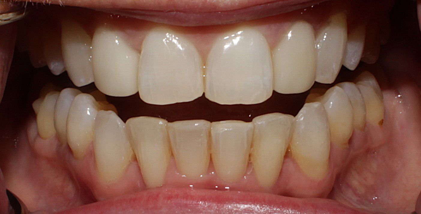 Smile Gallery case 1, after treatment, Westlake Village Dentist