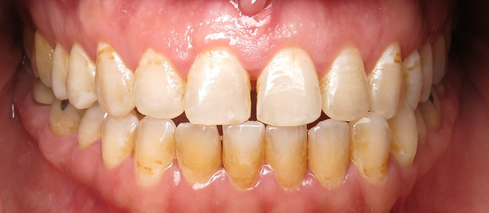 Smile Gallery case 10, before treatment, Westlake Village Dentist