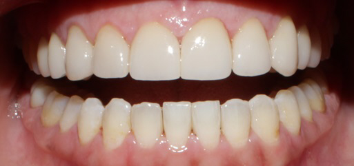 Smile Gallery case 10, after treatment, Westlake Village Dentist