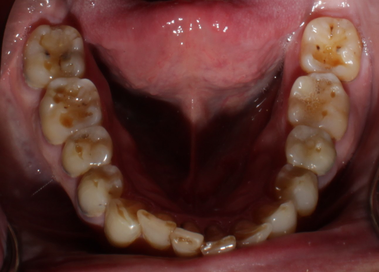 Smile Gallery case 11, before treatment, Westlake Village Dentist