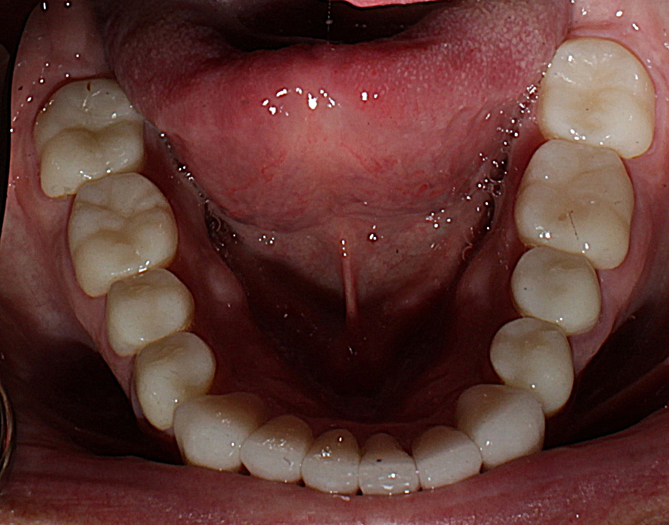 Smile Gallery case 11, after treatment, Westlake Village Dentist