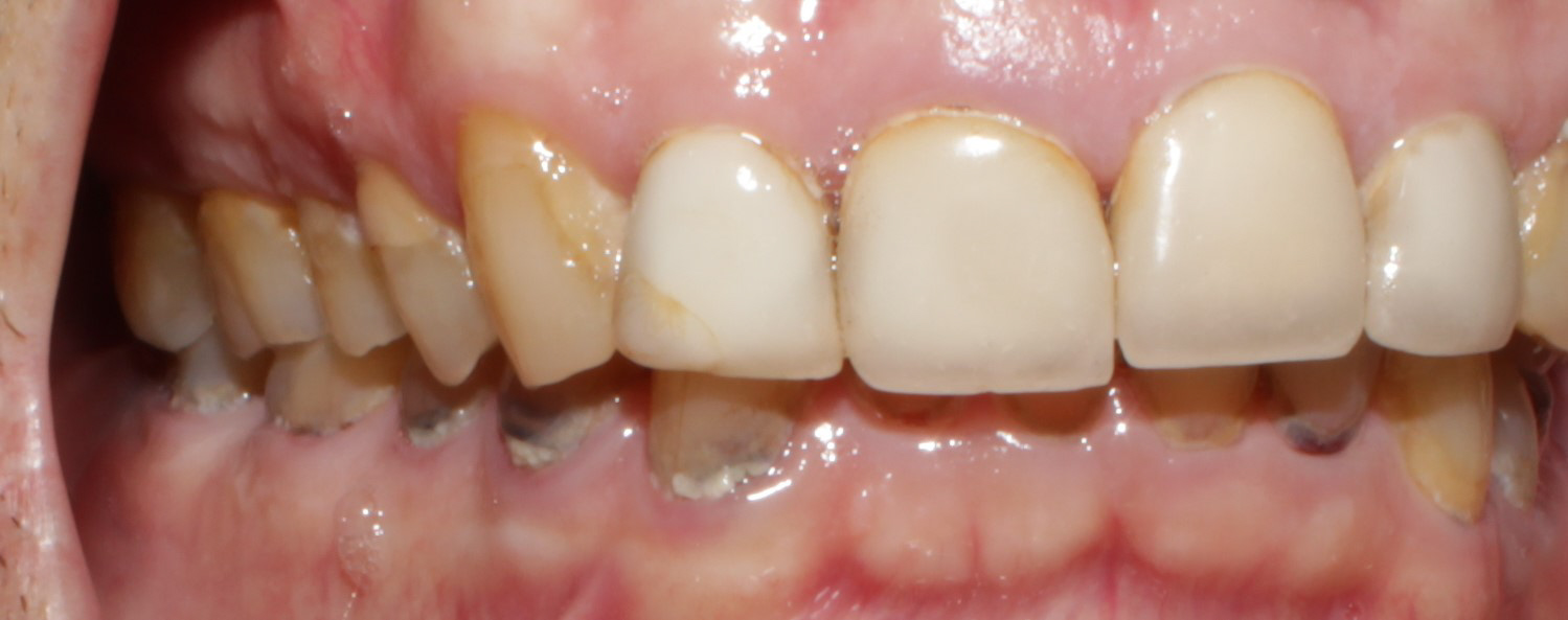 Smile Gallery case 12, before treatment, Westlake Village Dentist