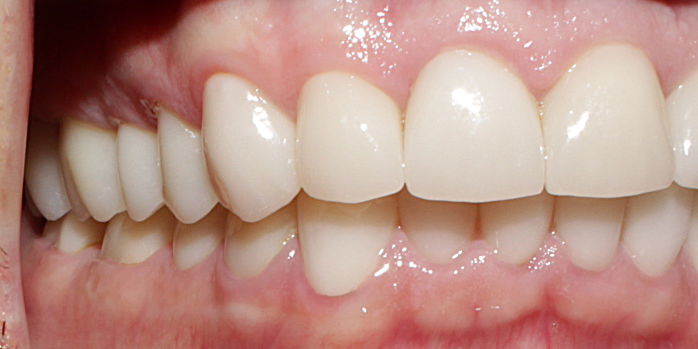 Smile Gallery case 12, after treatment, Westlake Village Dentist
