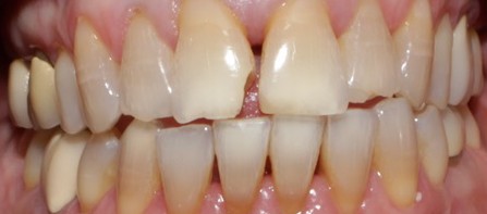 Smile Gallery case 13, before treatment, Westlake Village Dentist