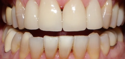 Smile Gallery case 13, after treatment, Westlake Village Dentist