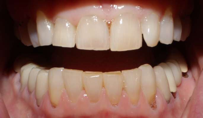 Smile Gallery case 14, before treatment, Westlake Village Dentist