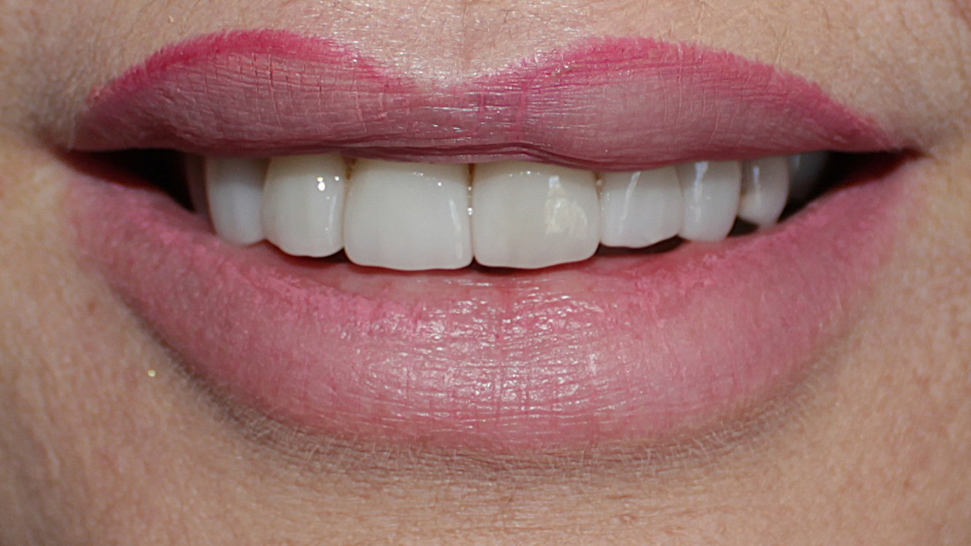 Smile Gallery case 14, after treatment, Westlake Village Dentist
