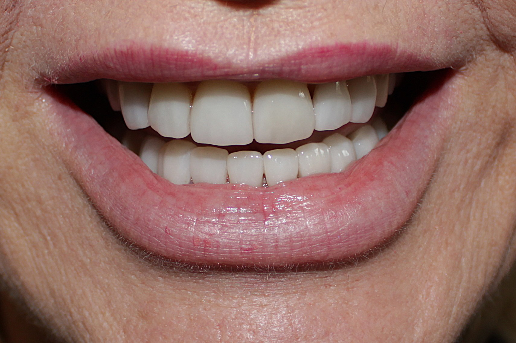 Smile Gallery case 14, after treatment, Westlake Village Dentist