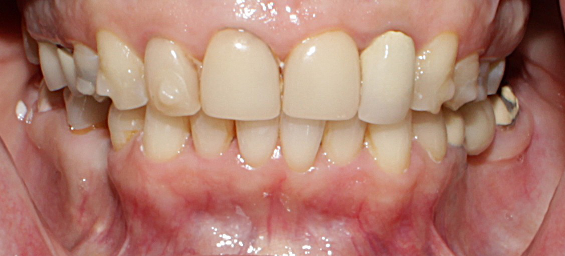Smile Gallery case 15, before treatment, Westlake Village Dentist