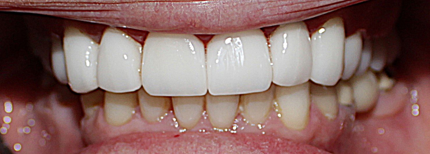 Smile Gallery case 15, after treatment, Westlake Village Dentist
