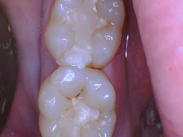 Smile Gallery case 16, before treatment, Westlake Village Dentist