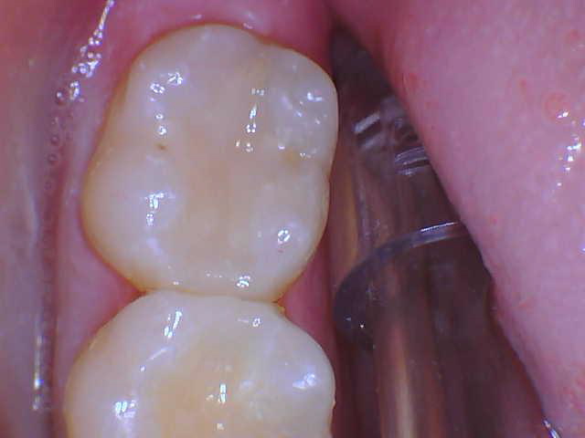 Smile Gallery case 16, after treatment, Westlake Village Dentist