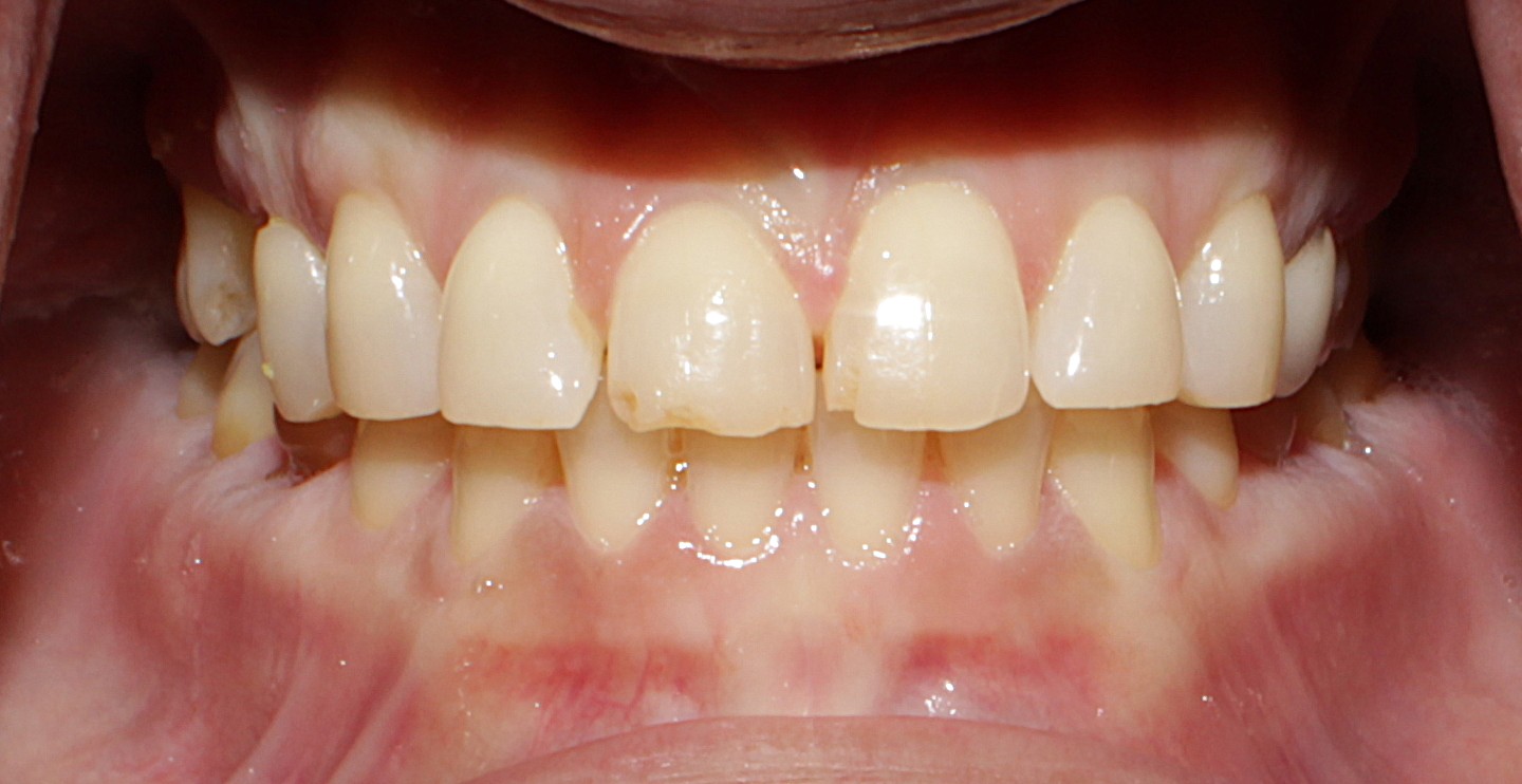 Smile Gallery case 17, before treatment, Westlake Village Dentist