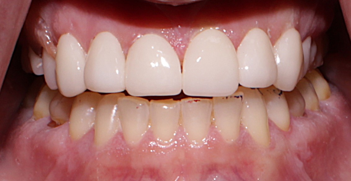 Smile Gallery case 17, after treatment, Westlake Village Dentist