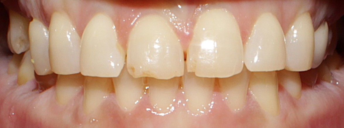 Smile Gallery case 18, before treatment, Westlake Village Dentist