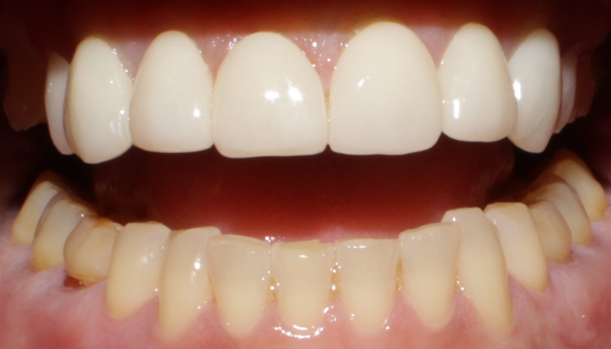 Smile Gallery case 18, after treatment, Westlake Village Dentist