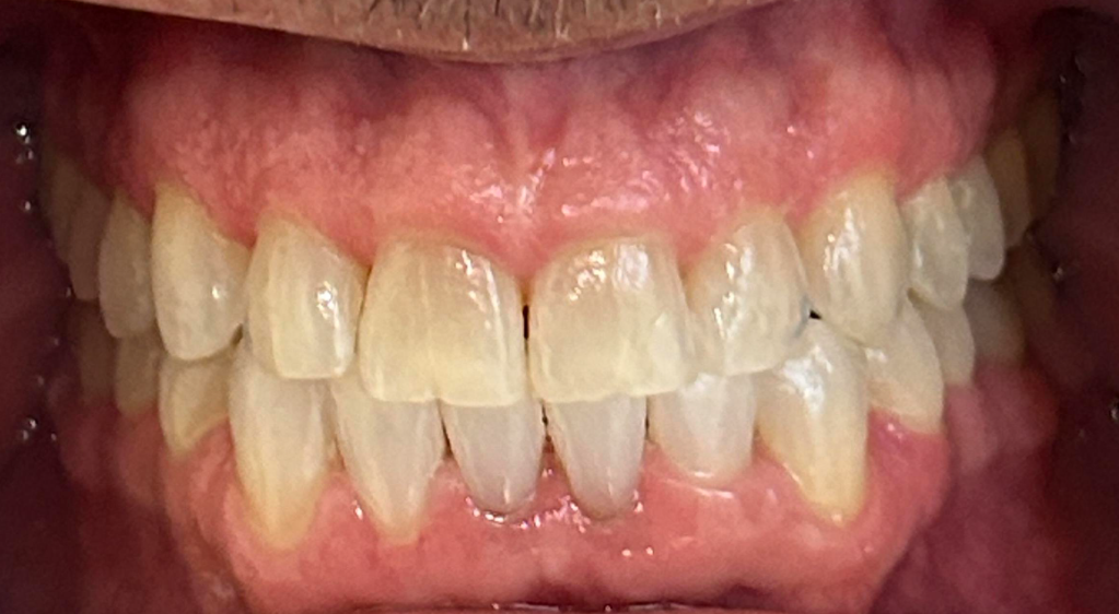 Smile Gallery case 19, before treatment, Westlake Village Dentist