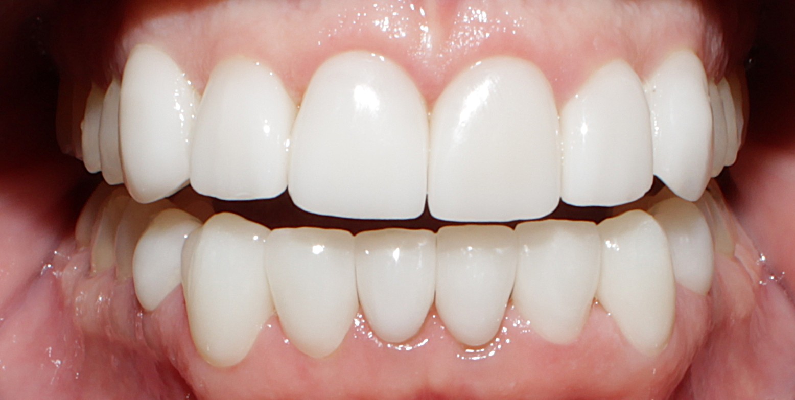 Smile Gallery case 19, after treatment, Westlake Village Dentist