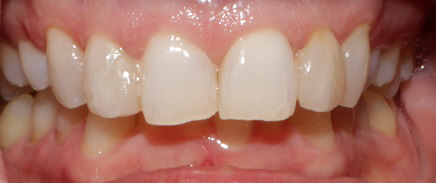 Smile Gallery case 2, before treatment, Westlake Village Dentist