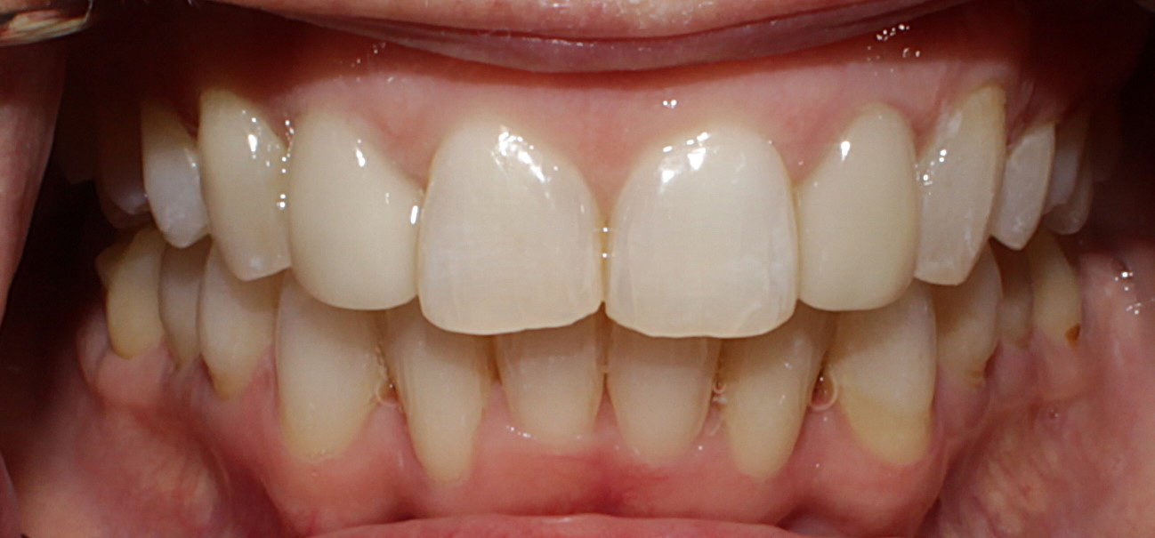 Smile Gallery case 2, after treatment, Westlake Village Dentist