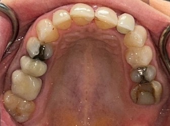 Smile Gallery case 20, before treatment, Westlake Village Dentist