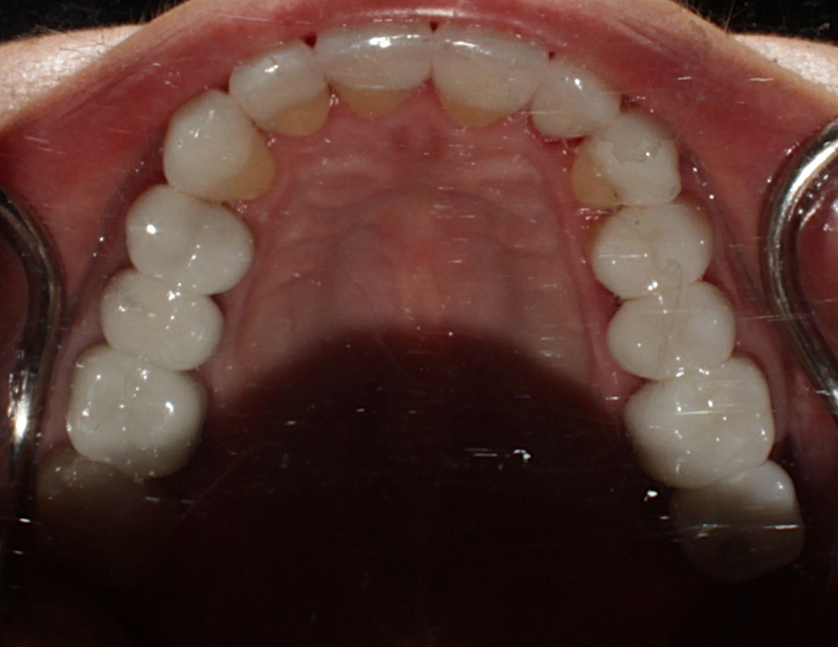 Smile Gallery case 20, after treatment, Westlake Village Dentist