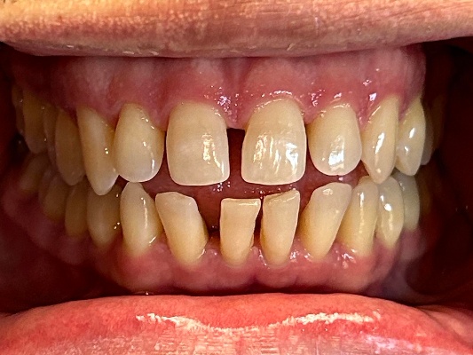 Smile Gallery case 3, before treatment, Westlake Village Dentist