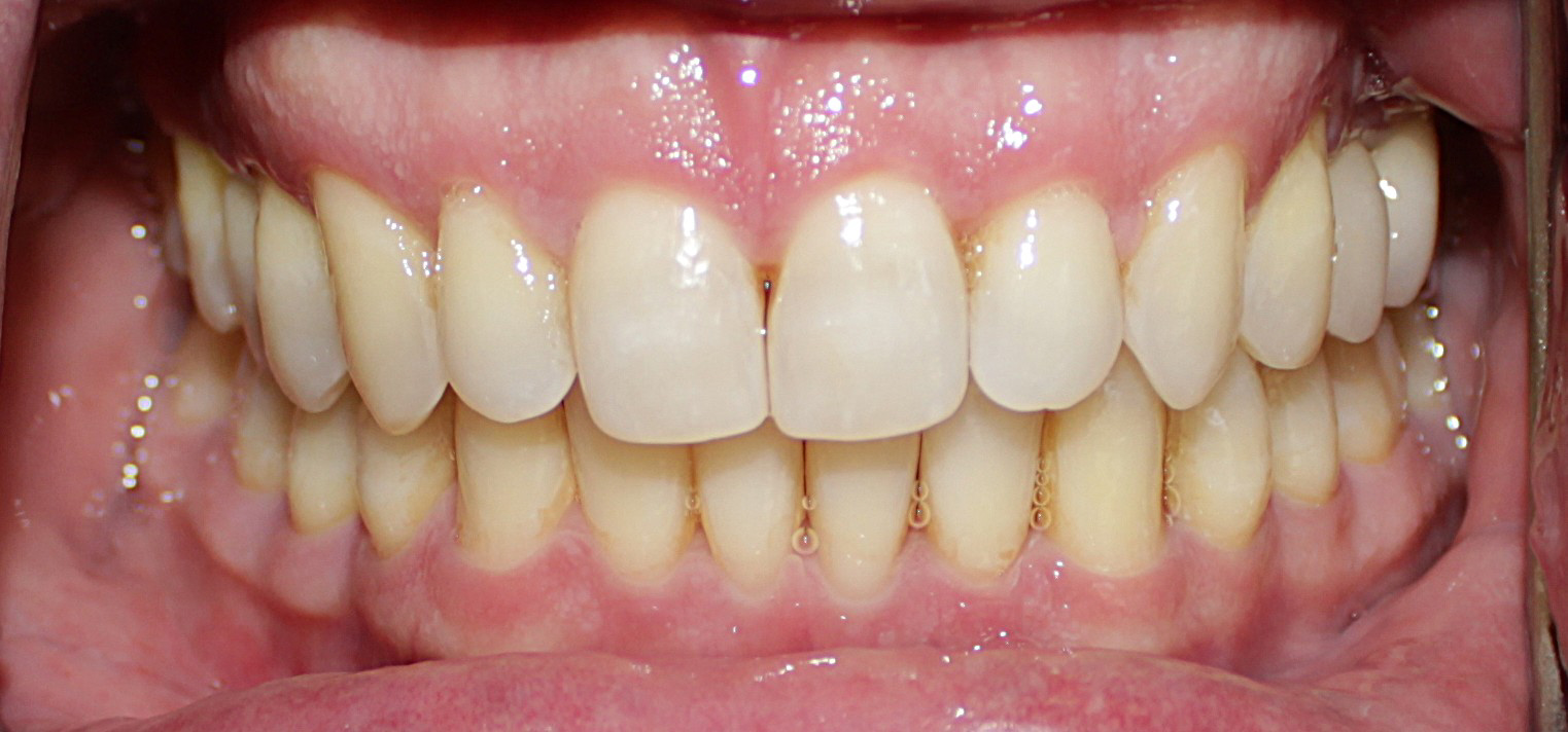 Smile Gallery case 3, after treatment, Westlake Village Dentist