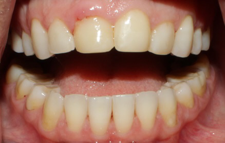 Smile Gallery case 4, before treatment, Westlake Village Dentist
