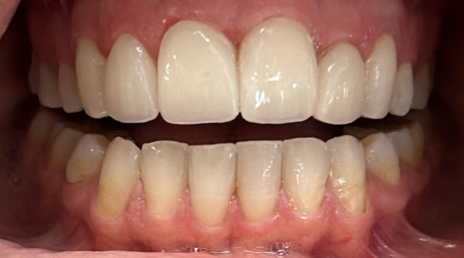 Smile Gallery case 4, after treatment, Westlake Village Dentist
