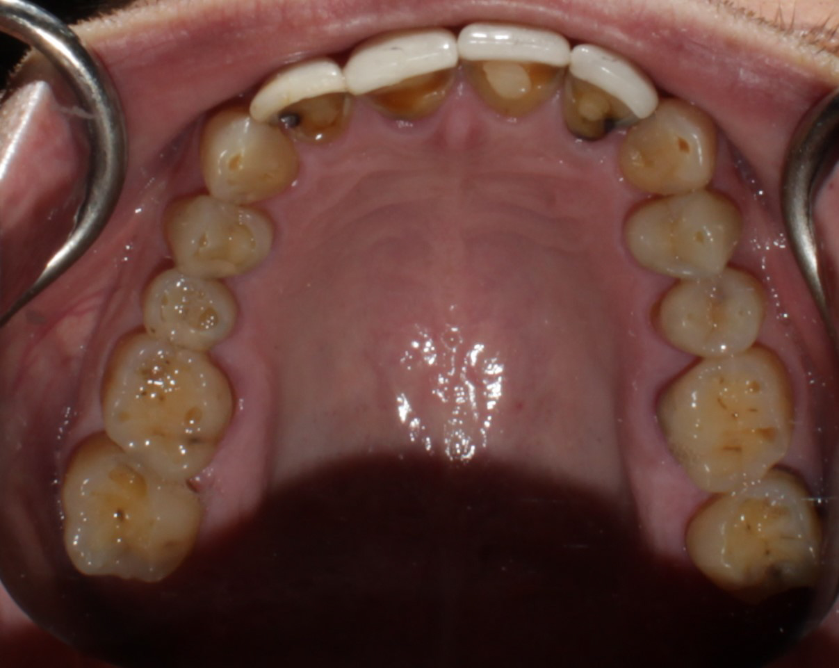 Smile Gallery case 5, before treatment, Westlake Village Dentist