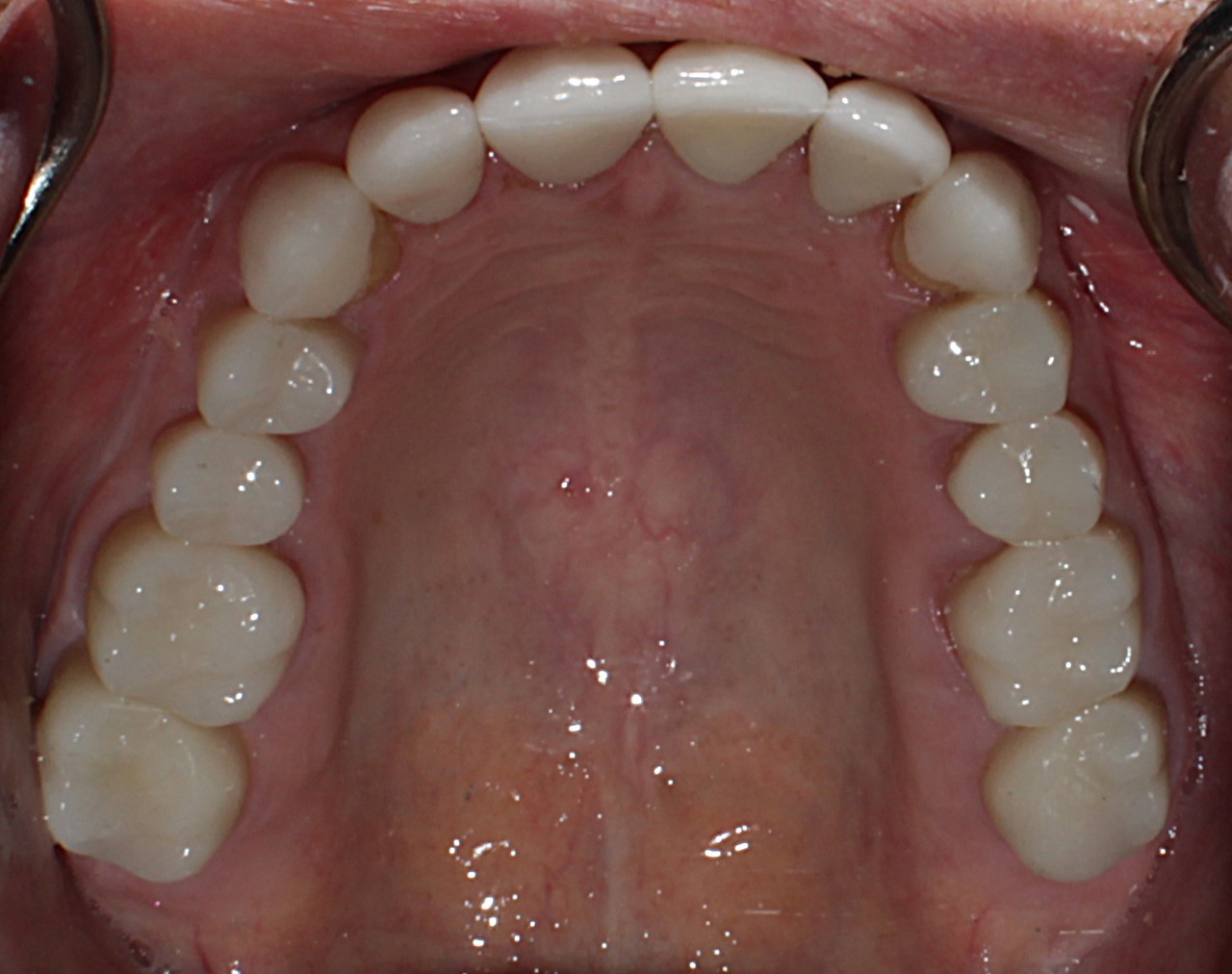 Smile Gallery case 5, after treatment, Westlake Village Dentist