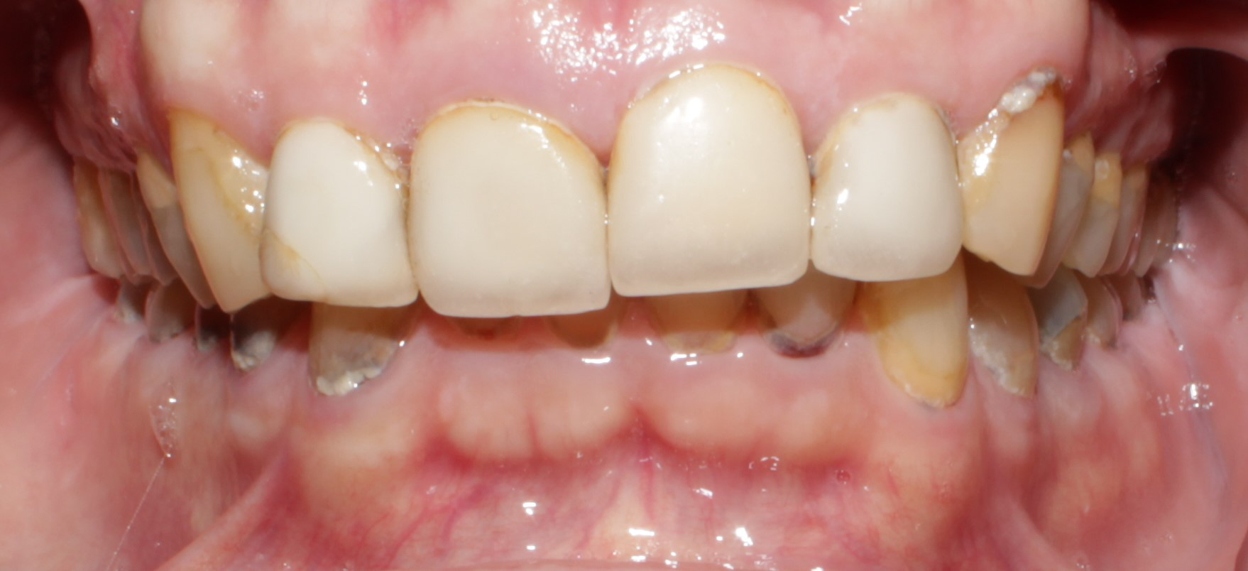 Smile Gallery case 6, before treatment, Westlake Village Dentist