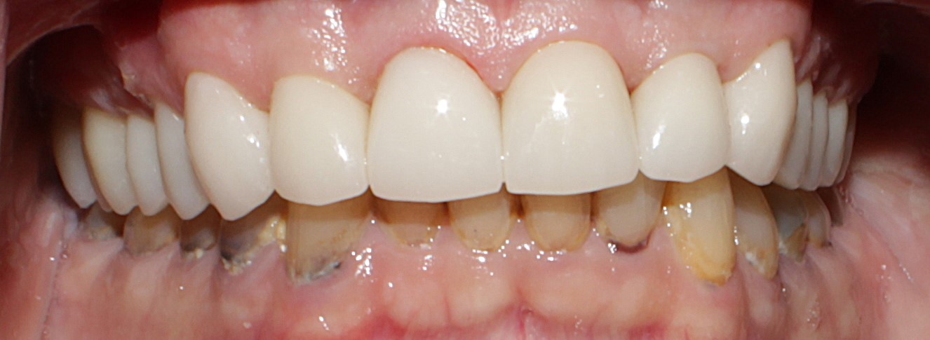 Smile Gallery case 6, after treatment, Westlake Village Dentist