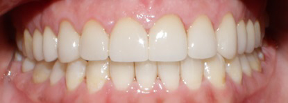 Smile Gallery case 7, after treatment, Westlake Village Dentist