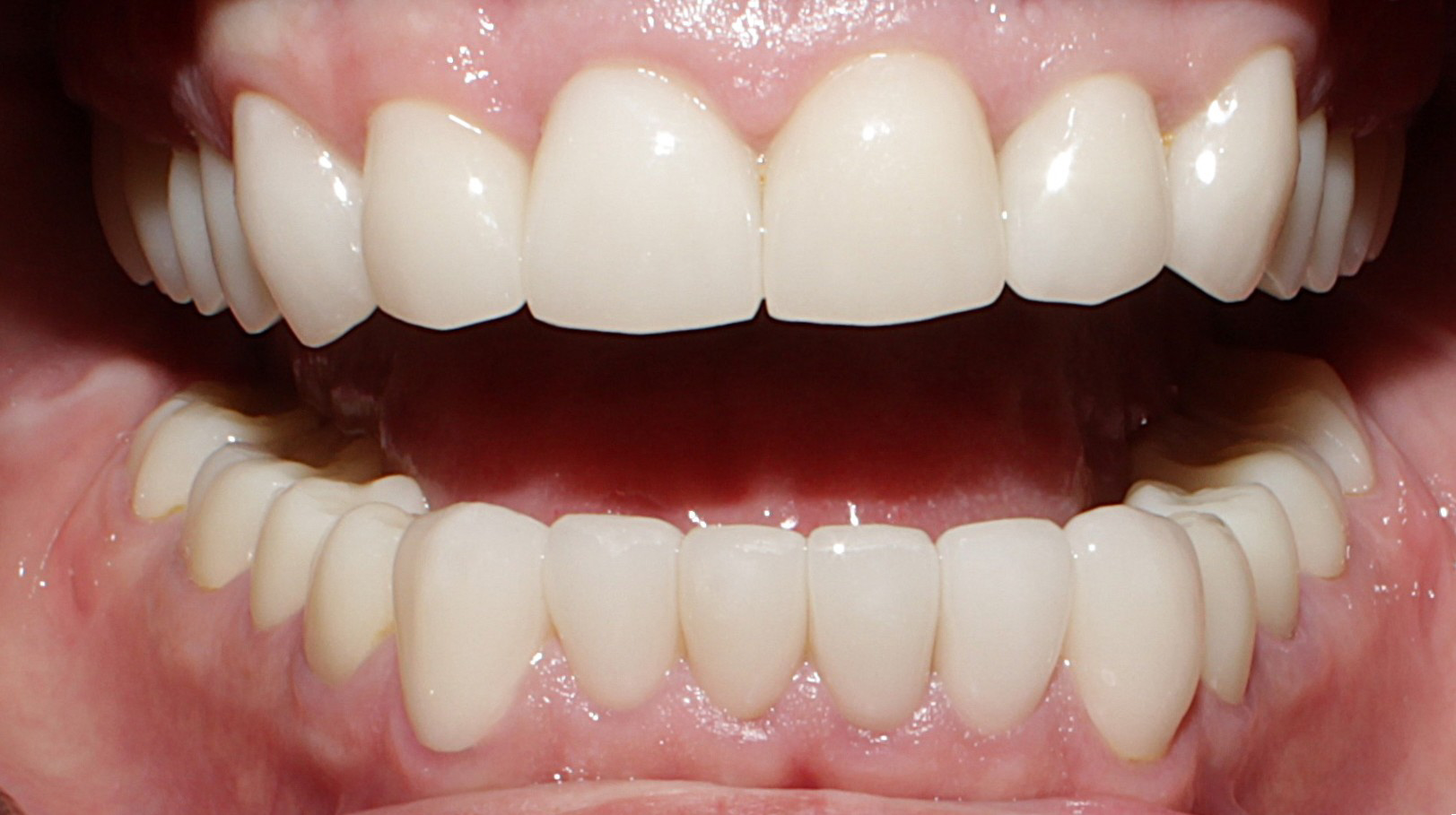 Smile Gallery case 7, after treatment, Westlake Village Dentist