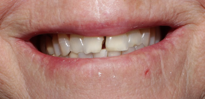 Smile Gallery case 8, before treatment, Westlake Village Dentist