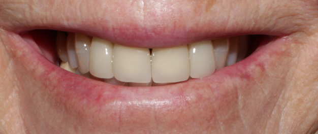 Smile Gallery case 8, after treatment, Westlake Village Dentist