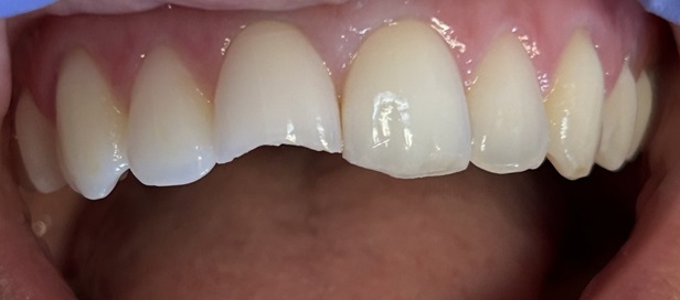 Smile Gallery case 9, before treatment, Westlake Village Dentist