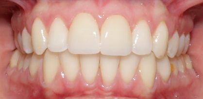 Smile Gallery case 9, after treatment, Westlake Village Dentist