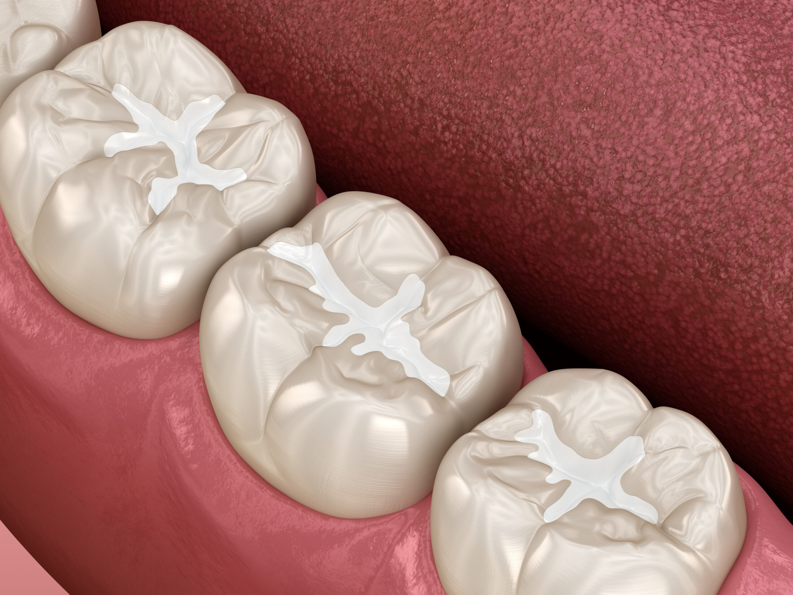 Cavity Fillings in Westlake Village, CA