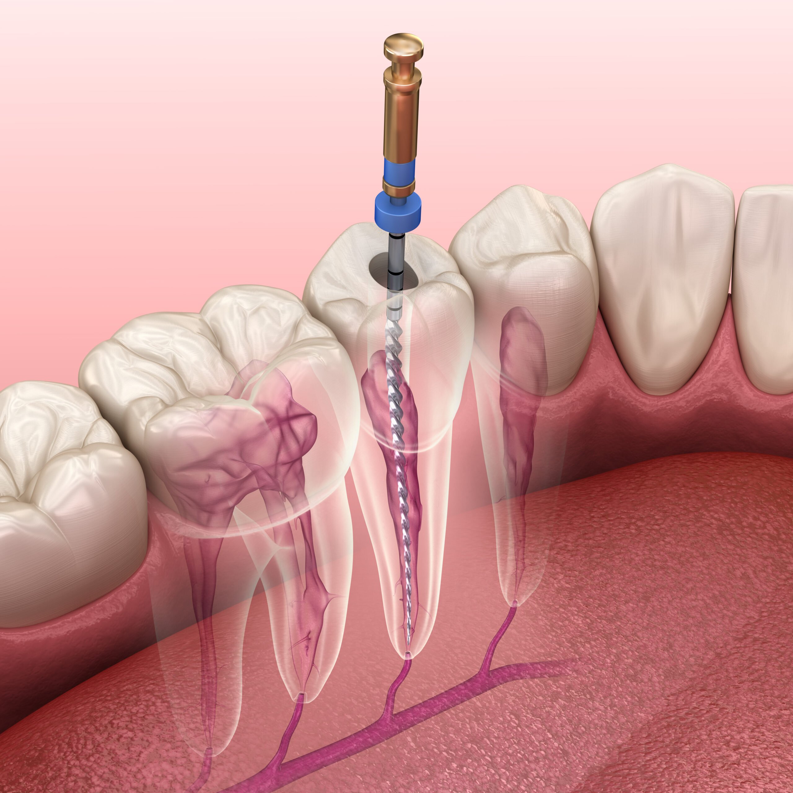 Root Canal Treatment in Westlake Village, CA