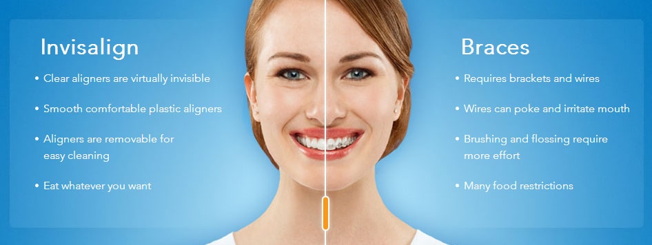 Invisalign2