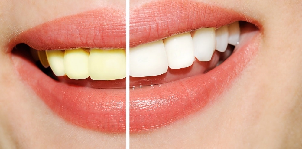 Teeth Whitening in Modern Times