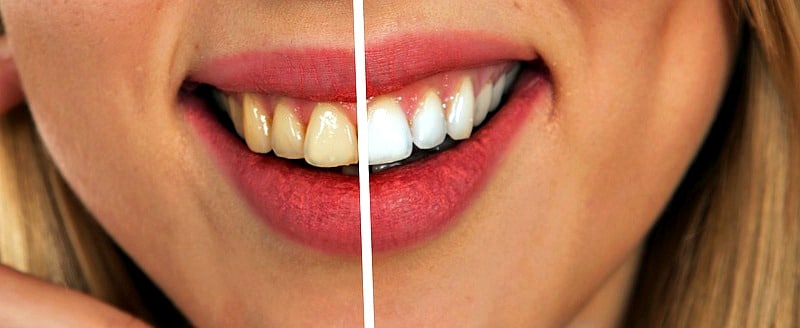 What Causes Teeth Stains?