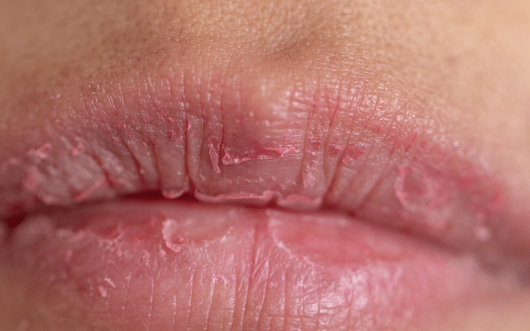 What Causes Dry Mouth?